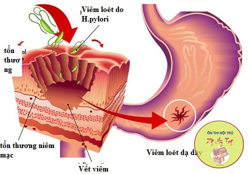 VIÊM